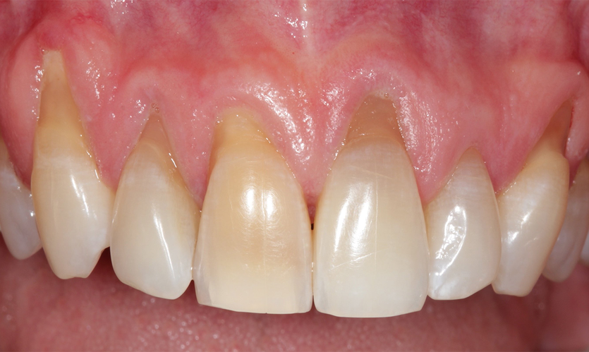 12-simple-ways-to-naturally-heal-receding-gums